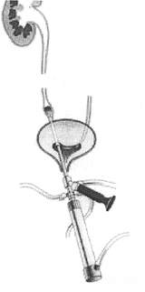 Illustration Ureteroenoskopie