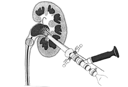Illustration PCNL